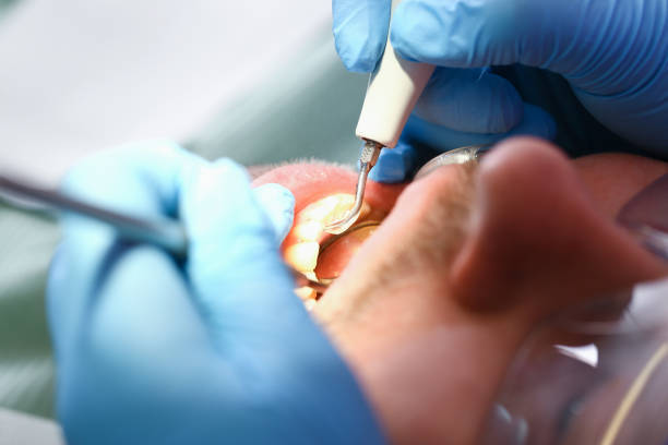 Best Emergency Wisdom Teeth Removal in Glendale, MS